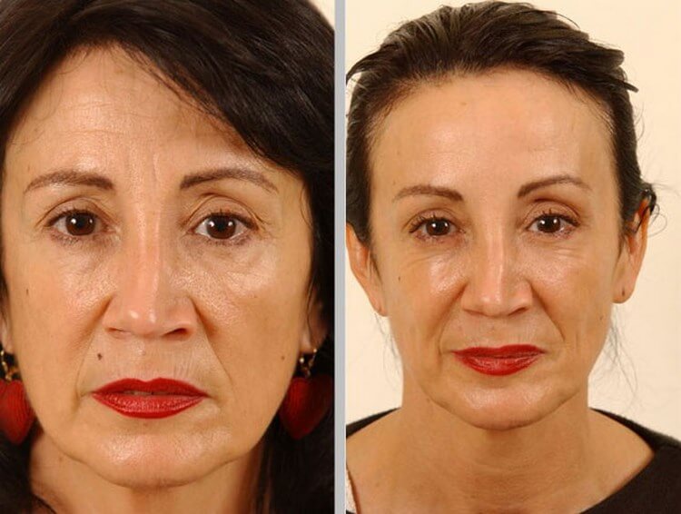 Ботекс морщин отзывы. Ботокс для лица до и после. Уколы красоты до и после.
