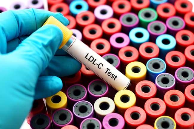 photo of ldl cholesterol test
