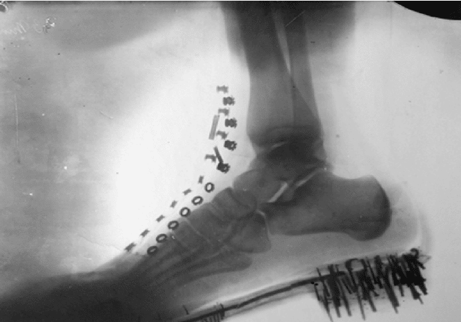 Nikola Tesla Foot X Ray